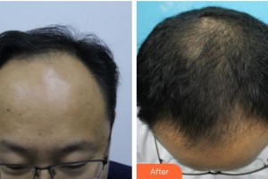 成都博愛(ài)醫(yī)院（胎記美容中心）余紅彬整形價(jià)格表附植發(fā)案例展示