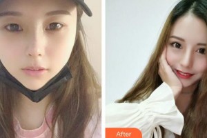 成都格萊麗醫(yī)療美容門(mén)診部石峰整形價(jià)格表附切開(kāi)雙眼皮案例展示