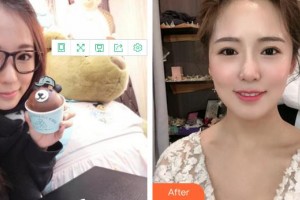 成都市中西醫(yī)結(jié)合醫(yī)院醫(yī)療美容科鄧宇恬整形價(jià)格表附牙綜合案例展示