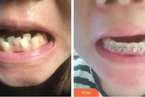 成都金琴口腔門(mén)診部王輝整形價(jià)格表附金屬托槽矯正案例展示