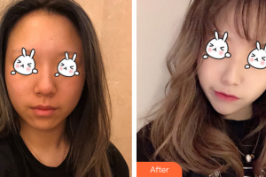 廣州紫馨美容醫(yī)院百束比古整形價格表附光子嫩膚案例展示