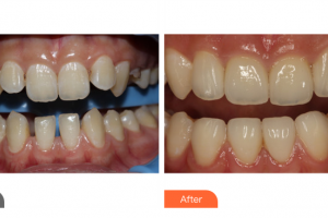 廣州晨曦醫(yī)療美容醫(yī)院李霽林整形價格表附牙齒矯正案例展示