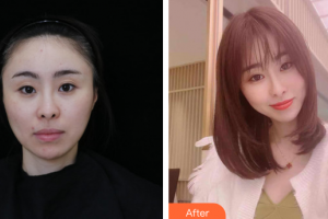 廣州海峽醫(yī)學整形美容醫(yī)院雷浚嶸整形價格表附膠原蛋白除皺案例展示