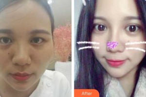 成都美呀皮膚醫(yī)學(xué)美容診所楊保華整形價(jià)格表附超激光美膚祛斑案例展示