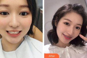 成都拉斐爾口腔門(mén)診部王雪梅整形價(jià)格表附牙齒矯正案例展示