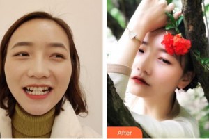 成都科瓦齒科門(mén)診部徐瑛整形價(jià)格表附金屬托槽矯正案例展示