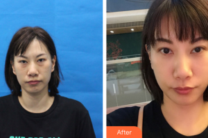 廣州晨曦醫(yī)療美容醫(yī)院游海峰整形價格表附去眼袋案例展示