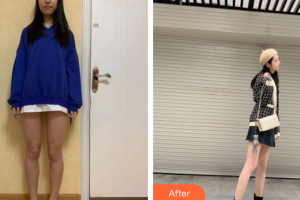 廣州晨曦醫(yī)療美容醫(yī)院謝秋梅整形價格表附吸脂瘦大腿案例展示