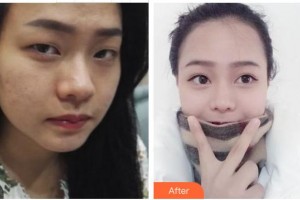 成都忠愛(ài)醫(yī)療美容診所王瑩瑩整形價(jià)格表附眼部綜合案例展示