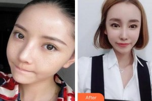 成都潤禾皮膚病?？漆t(yī)院殷明坤整形價格表附祛斑案例展示