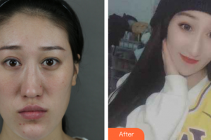 廣州海峽醫(yī)學整形美容醫(yī)院呂方中整形價格表附雙顎畸形矯正術案例展示