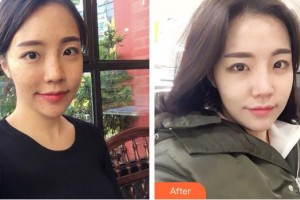 成都潤禾皮膚病?？漆t(yī)院李艷整形價格表附祛痘美膚案例展示