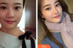 成都安莎貝拉醫(yī)療美容門診部樸炯埈整形價格表附鼻部綜合案例展示