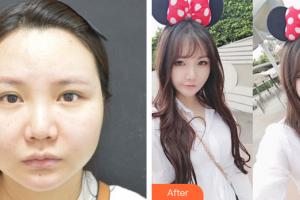 廣州軍區(qū)武漢總醫(yī)院醫(yī)學整形美容中心郭亮整形價格表附面部輪廓案例展示