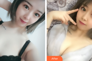 廣州洛萱醫(yī)療美容門診部周紹龍整形價格表附自體脂肪隆胸案例展示