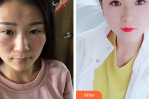 廣州軍區(qū)武漢總醫(yī)院醫(yī)學整形美容中心孔生生整形價格表附激光祛斑案例展示