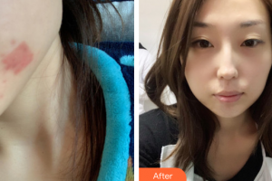 廣州軍區(qū)武漢總醫(yī)院醫(yī)學整形美容中心桂思整形價格表附點陣激光案例展示