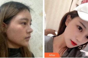 成都安莎貝拉醫(yī)療美容門診部周順波整形價格表附鼻部綜合案例展示