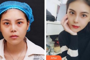 成都臻愛唯美醫(yī)療美容醫(yī)院王皓民整形價格表附隆鼻案例展示