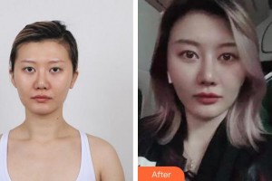 成都友誼醫(yī)院李萍整形價格表附鼻部手術案例展示