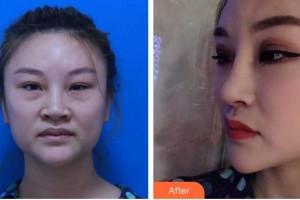 成都友誼醫(yī)院柏雨青整形價格表附鼻部綜合案例展示