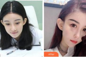 成都瑞麗詩美學植發(fā)門診部姜印整形價格表附發(fā)際線案例展示