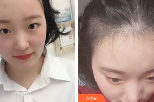 成都絲緣毛發(fā)醫(yī)療美容門診部陳祖慶整形價格表附植發(fā)案例展示