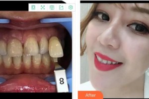 成都茁悅口腔診所張達良整形價格表附牙綜合案例展示