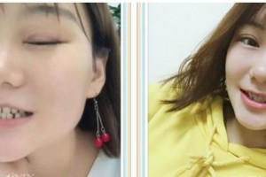 成都茁悅口腔診所胡玲整形價格表附牙齒矯正案例展示