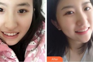 成都茁悅口腔診所張瑞澤整形價格表附牙綜合案例展示