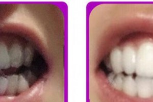 成都康橋眼科醫(yī)院王素卿整形價格表附牙綜合案例展示