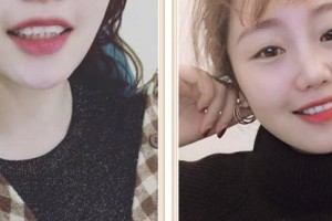 成都康橋眼科醫(yī)院鄭海燕整形價格表附隱形矯正案例展示