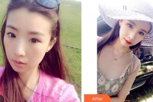 成都愛迪眼科醫(yī)院鄧彥整形價格表附眼部綜合案例展示