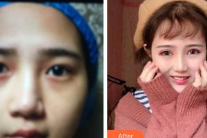 成都愛迪眼科醫(yī)院劉華整形價格表附眼部整形案例展示