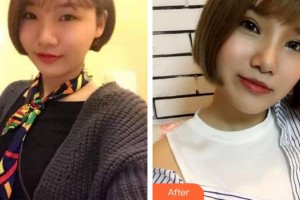 成都愛迪眼科醫(yī)院吳瑛整形價格表附眼部整形案例展示