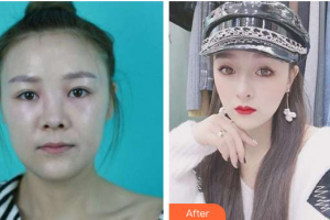 廣州軍區(qū)武漢總醫(yī)院醫(yī)學整形美容中心孫艷春整形價格表附面包臉到鴨蛋臉變形記案例展示