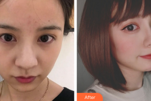 廣州軍美整形醫(yī)院張衛(wèi)華整形價格表附光子嫩膚全臉案例展示