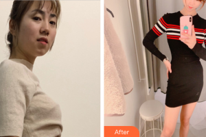 廣州軍區(qū)武漢總醫(yī)院醫(yī)學整形美容中心楊凌云整形價格表附光子套餐案例展示