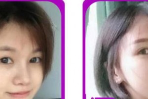 成都愛迪眼科醫(yī)院丁儉整形價格表附切開雙眼皮案例展示