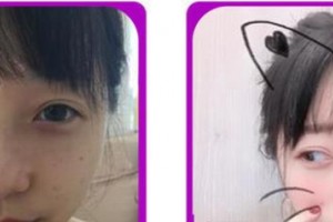 成都愛迪眼科醫(yī)院何順華整形價格表附雙眼皮切開案例展示