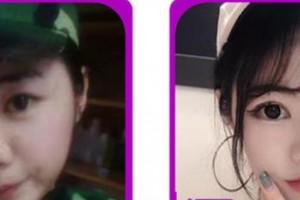 成都愛迪眼科醫(yī)院韋斌整形價格表附切開雙眼皮案例展示