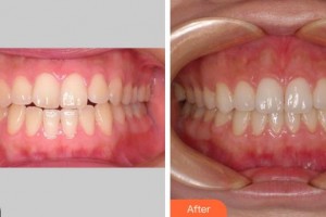 成都君臣口腔門(mén)診部霖整形價(jià)格表附牙齒正畸案例展示