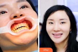 成都仁惠口腔門(mén)診部葉露整形價(jià)格表附瓷貼面案例展示