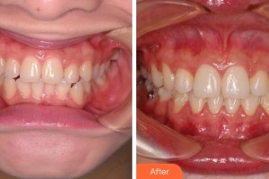 成都純?？谇辉\所劉明曦整形價(jià)格表附牙齒正畸案例展示