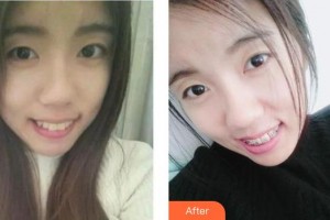 成都君臣口腔門(mén)診部王君臣整形價(jià)格表附金屬托槽矯正案例展示