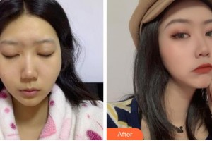 成都天姿醫(yī)療美容門(mén)診部李雯雯整形價(jià)格表附顴骨內(nèi)推案例展示