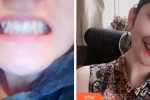 成都華陽(yáng)微笑口腔診所王冰蓉整形價(jià)格表附牙齒矯正案例展示