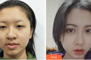 成都天姿醫(yī)療美容門(mén)診部譚超整形價(jià)格表附切開(kāi)雙眼皮案例展示
