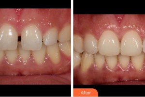 成都龍普蘭特口腔門(mén)診部王曉霞整形價(jià)格表附牙綜合案例展示