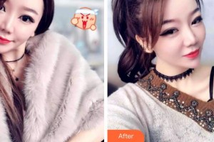 成都潔西口腔診所黃維慶整形價(jià)格表附牙齒矯正案例展示